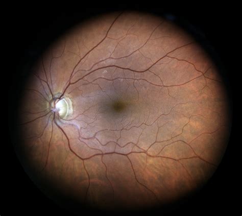 test for optic nerve damage